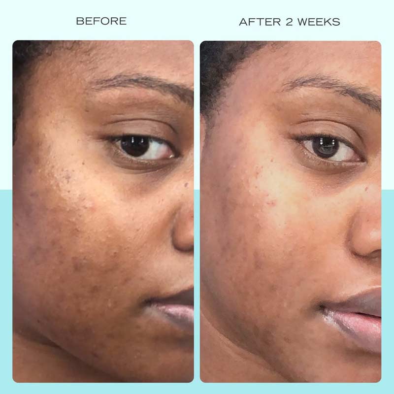 First Aid Beauty Dark Spot Serum with Niacinamide Discontinued